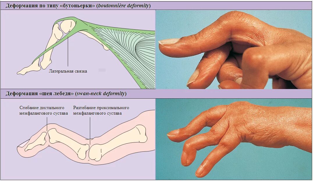 Сгибательная контрактура сустава. Шея лебедя ревматоидный артрит. Контрактура при ревматоидном артрите. Ревматоидный артрит деформация кисти. Разрыв сухожилий разгибателей кисти.