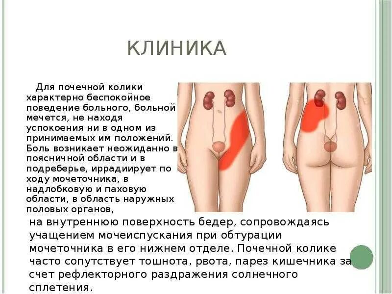 Острая почечная колика локализация боли. Почечная колика локализация болей. Боль при почечной колике.