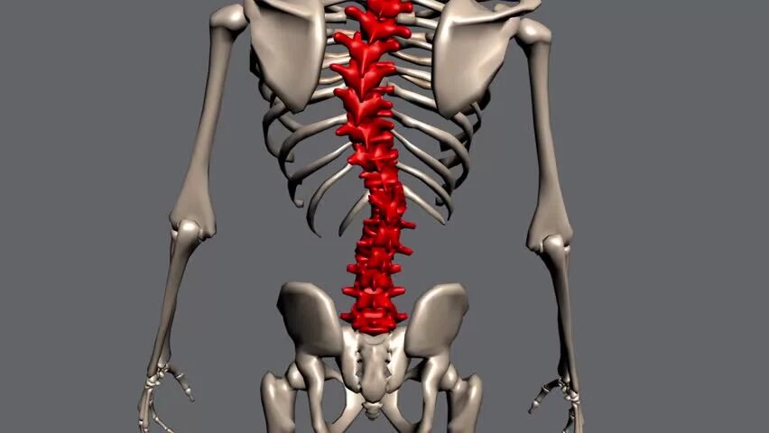Скелет человека со сколиозом. Кривой позвоночник скелет. Женщина с нарушением в развитии скелета