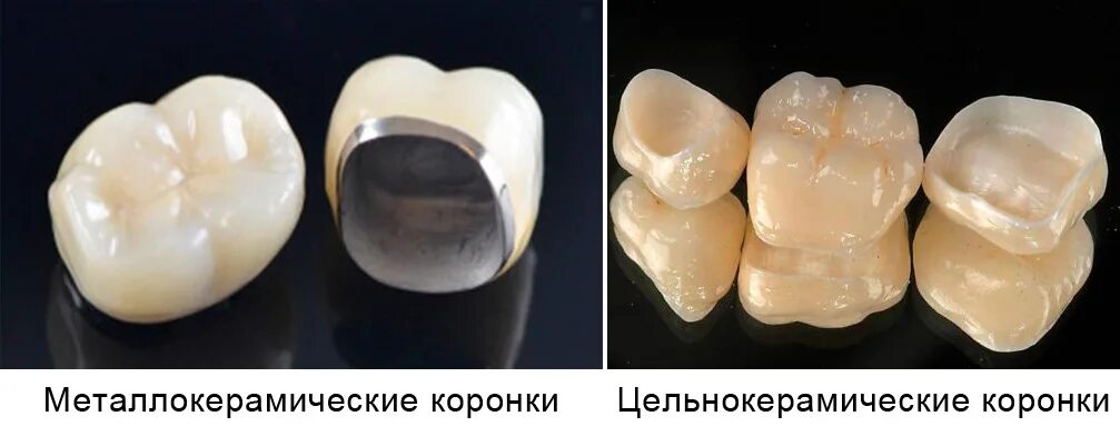 Почему не изготавливают цельнокерамических подошв. Цельнокерамическая коронка диоксид циркония. Металлокерамическая коронка а1 120. Металлокерамика, керамика, диоксид циркония. Керамические металлокерамические  диоксид циркония коронки.