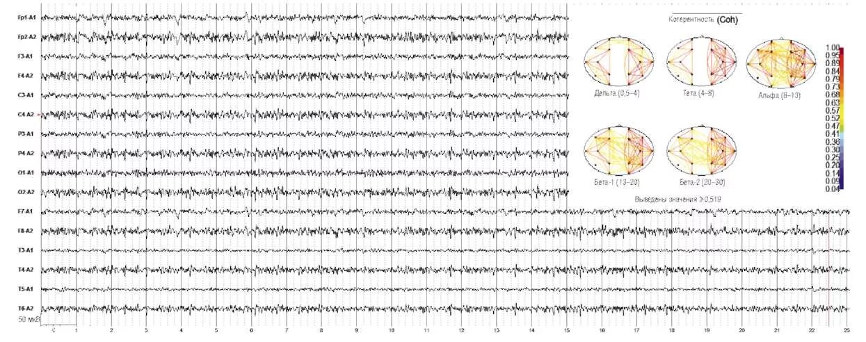 ЭЭГ. Электроэнцефалография + когерентный анализ. ЭЭГ при паркинсоне. Шаблоны по ЭЭГ. Ээг дневное ребенку