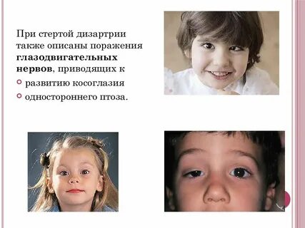 Язык при дизартрии