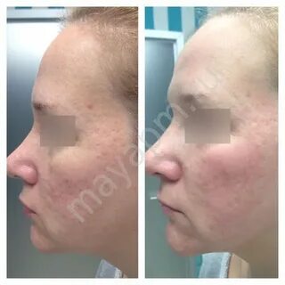 Лазерная шлифовка кожи skinlift