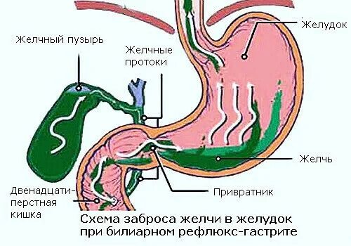 Желудок и желчный пузырь. Патогенез дуоденогастрального рефлюкса. При забросе желчи в желудок. Лечение дуодено-гастрального рефлюкса схема. Желчь в желудке причины.