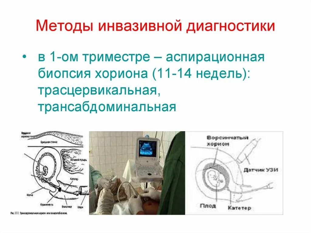 Инвазивные методы исследования плода. Инвазивные методы диагностики в акушерстве. Методы обследования внутриутробного состояния плода. Инвазивный метод диагностики. Инвазивный тест при беременности