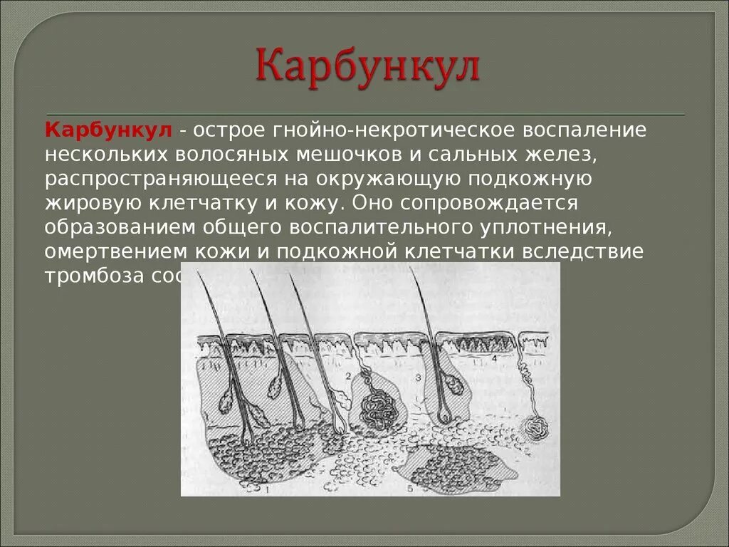 Плотный остро. Острое воспаление сальной железы (фурункул). Карбункул гнойничковые заболевания кожи. Фурункул абсцесс флегмона. Каргунул.