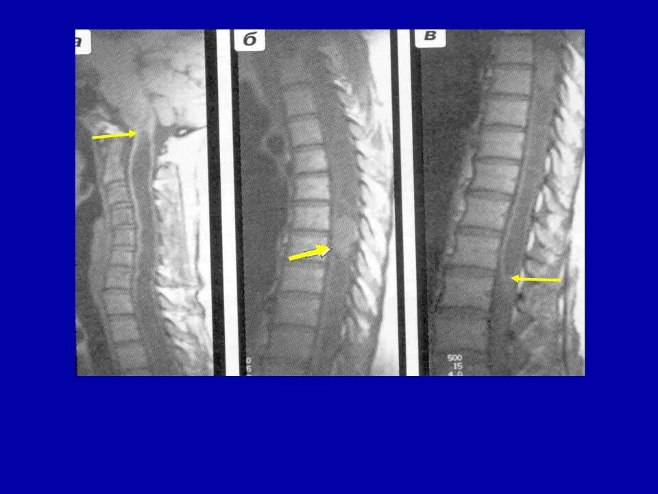 Кт экстрамедуллярная опухоль спинного мозга. Интрамедуллярные опухоли спинного мозга мрт. Интрамедуллярная опухоль спинного мозга симптомы. Интрамедуллярная опухоль спинного мозга шейного отдела позвоночника. Интрамедуллярные опухоли спинного