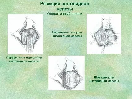 Щитовидная железа хирургическое вмешательство