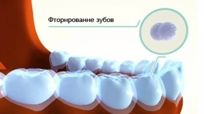 Фтор зубная эмаль. Глубокое фторирование эмали зуба (1 зуб). глубокое фторирование твердых тканей зубов. глубокое фторирование зубов методика. фторирование зубов детям.