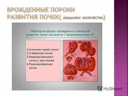Врожденный порок развития почки