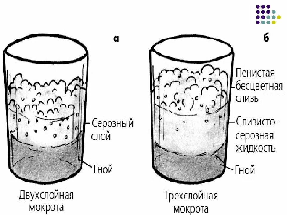 Таблица мокроты. Консистенция мокроты. Характер мокроты. Серозной мокроты консистенции. Схема вид мокроты.