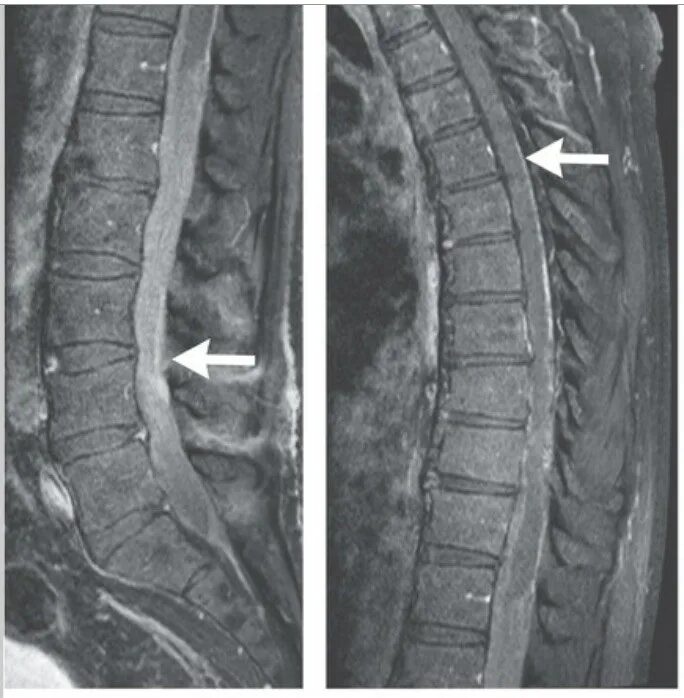 Метастазы в спинном мозге на мрт. Липома спинного мозга мрт. Опухоль спинного мозга мрт. Интрадуральная липома мрт. Интрамедуллярные опухоли спинного