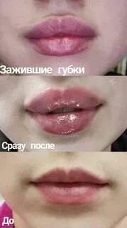 Как заживают губы после увеличения