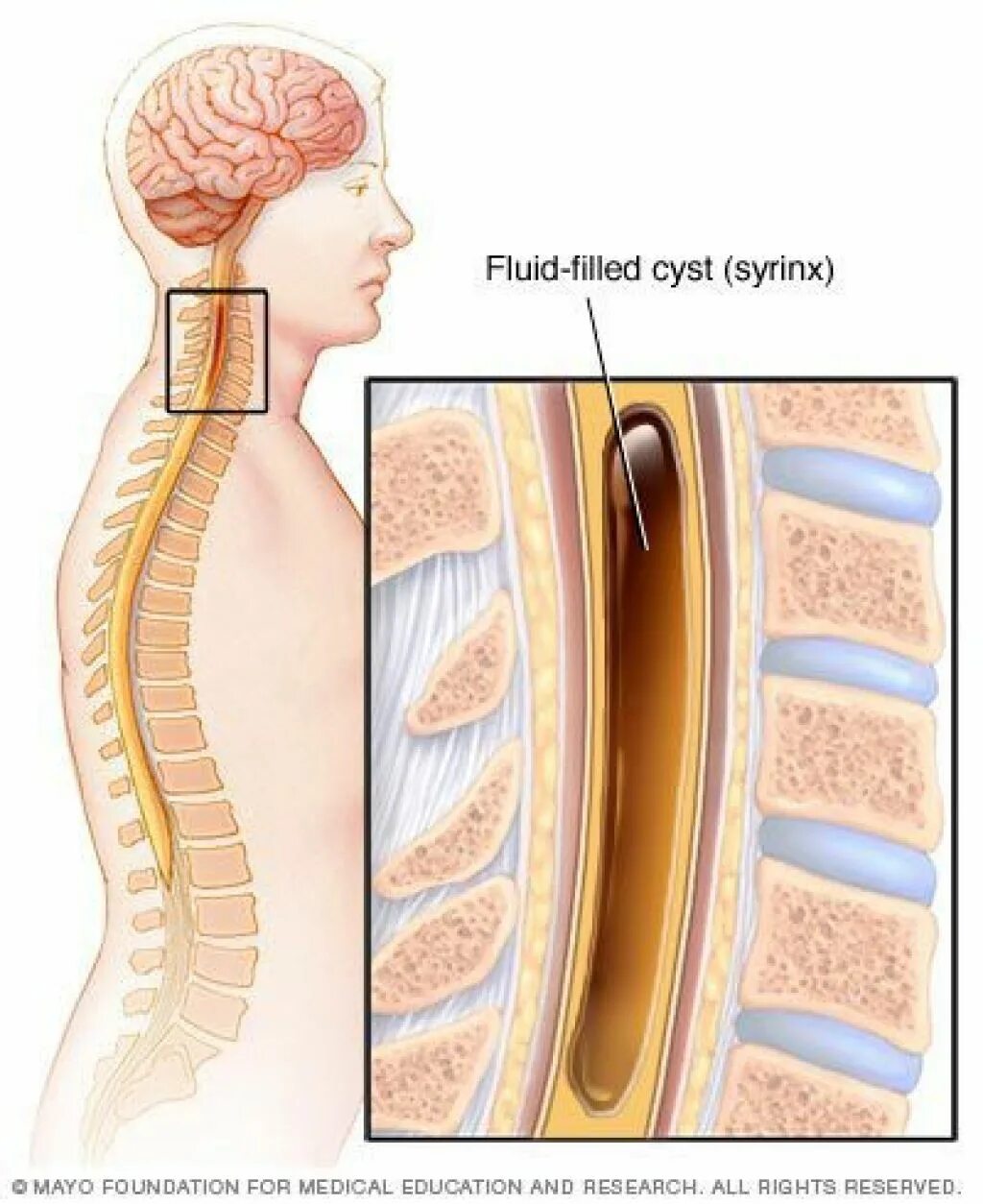 Сирингомиелия шейного отдела позвоночника мрт. Сирингомиелия грудного отдела позвоночника. Гидромиелия спинного мозга шейного отдела позвоночника.