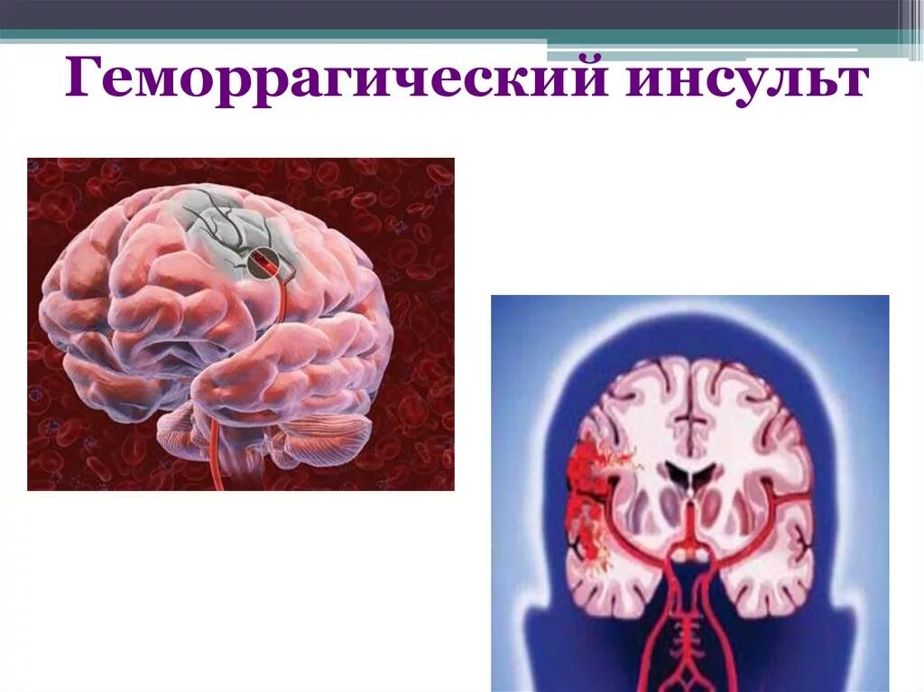 Нарушение мозгового кровообращения типы. Геморрагический инсульт и ишемический инсульт. ОНМК по геморрагическому типу. ОНМК геморрагический инсульт. Внутрижелудочковые кровоизлияния геморрагический инсульт.