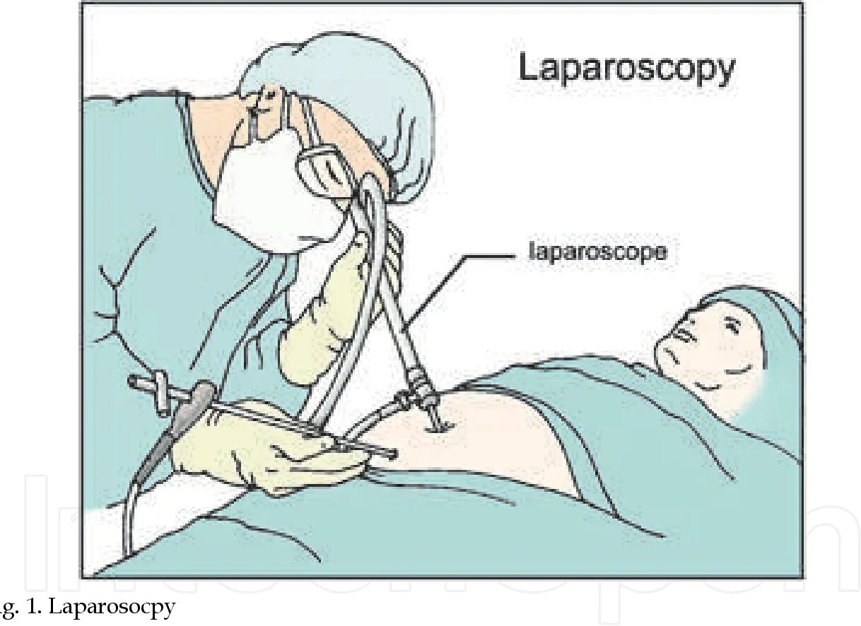 Через сколько снимать дренаж. Лапароскопическая аппендэктомия лапароскопия. Лапароскопия после операции. Лапароскопия аппендицита. Лапароскопия брюшной полости.