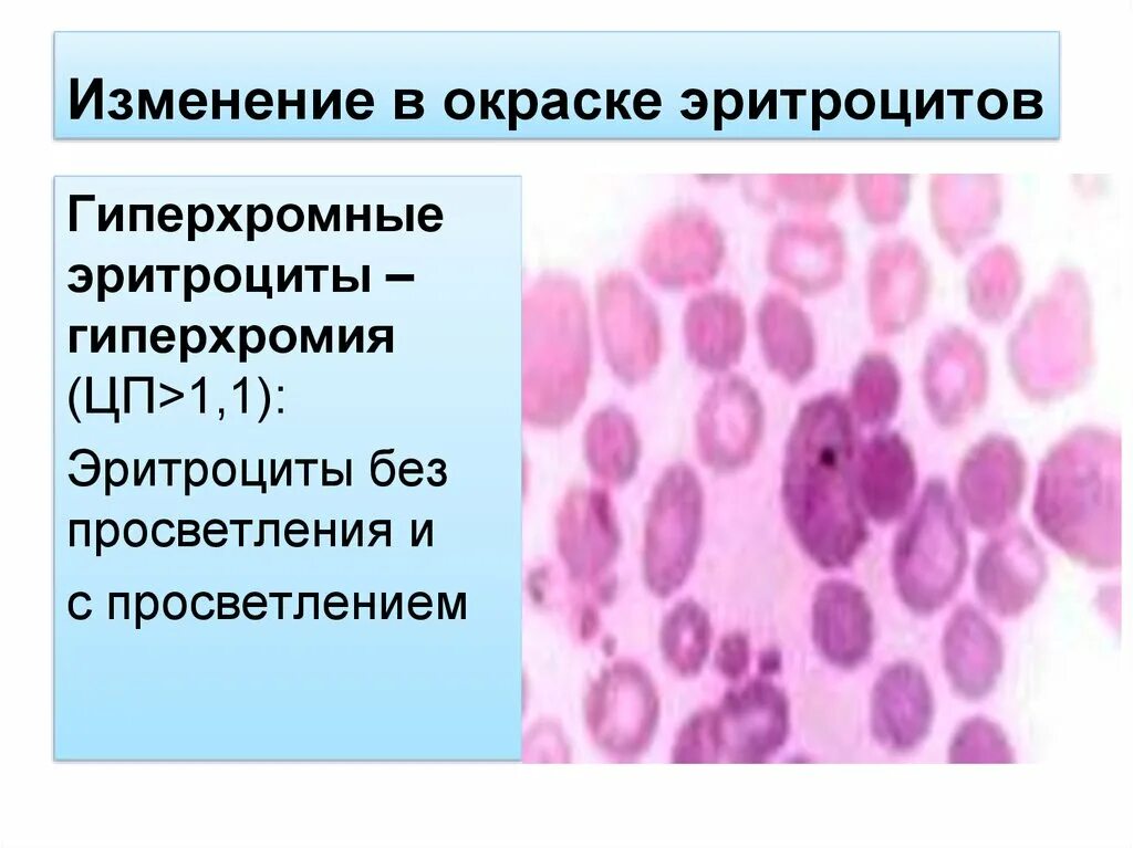 Гипохромия выраженная. Гипохромия и гиперхромия. гиперхромия эритроцитов при в12. в12 анемия эритроциты гиперхромная. изменение окраски эритроцитов при анемии.