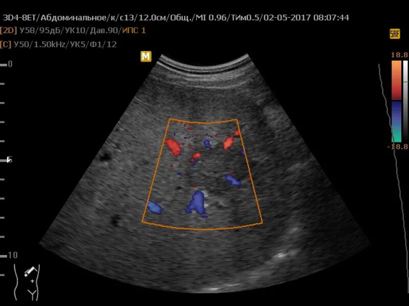Образование в печени на узи. УЗИ молочных желез цветовое допплеровское картирование. Образования печени на УЗИ. Кистозно-Солидное образование печени УЗИ. Очаговые образования в печени на УЗИ.