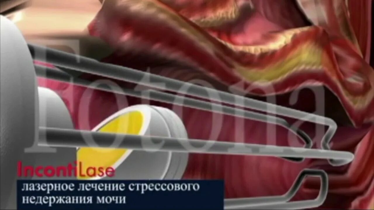 Лечение недержания у женщин лазером. Лечение недержания у женщин лазером. Лазерное недержание мочи. Картинка диагностики лазерного. Лазерная терапия при краурозе.