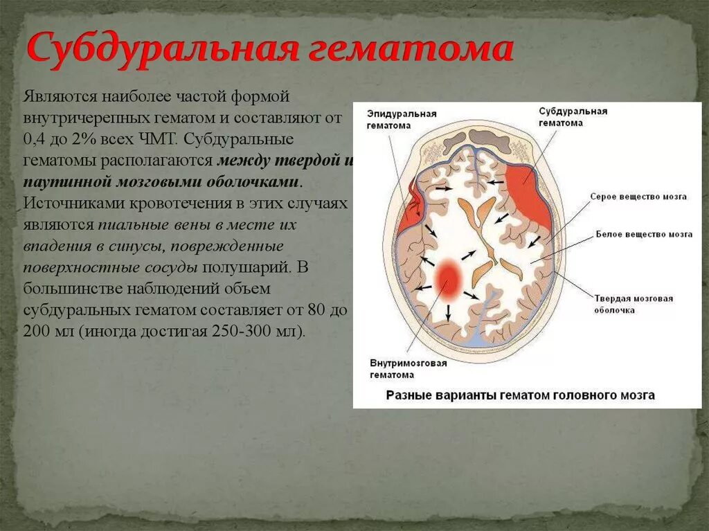 Субдуральная гематома и эпидуральная головного. Субдуральная гематома черепа. Признаками травматической субдуральной гематомы. Острая субдуральная гематома симптомы. Субдуральная гематома лечение