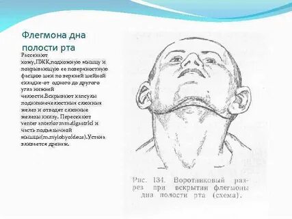 Мкб дна полости рта