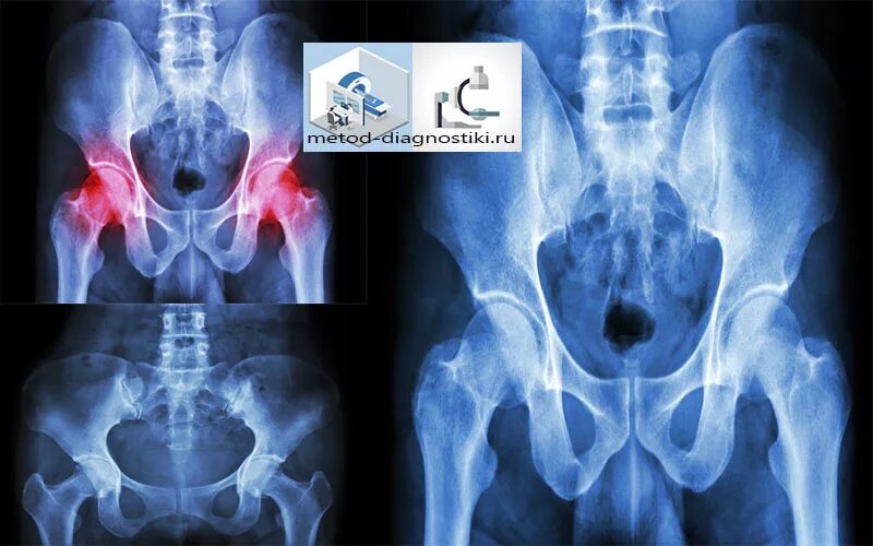варикозное расширение вен таза мрт. магнитно резонансная томография яичников. магнитно-резонансная томография органов малого таза. компьютерная томография (кт) малого таза. подготовка к кт таза у женщин.