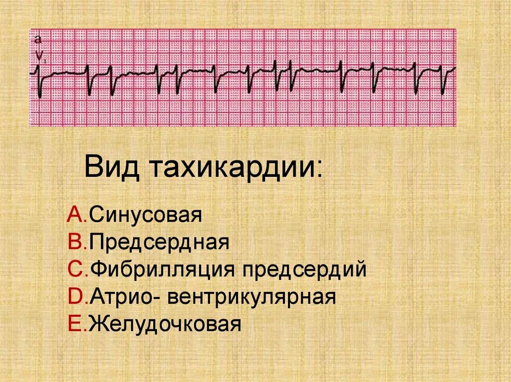 Синусовая тахикардия вертикальное. Синусовая и предсердная тахикардия. Виды тахикардии. Виды учащенного сердцебиения. Симптомы при синусовой тахикардии.