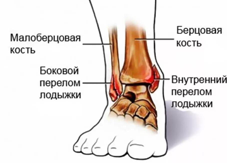 Латеральная лодыжка голеностопного сустава. Перелом лодыжки пронация. Перелом с вывихом голеностопного сустава. Перелом наружной латеральной лодыжки без смещения. Операция малоберцовой кости