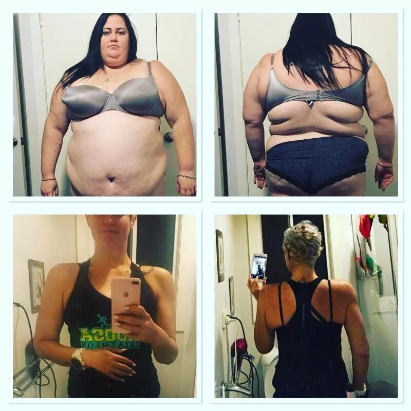 Похудение операция отзывы. Похудение операция отзывы. Похудение операция отзывы. Бериатрия желудка до и после. Похудение операция отзывы.