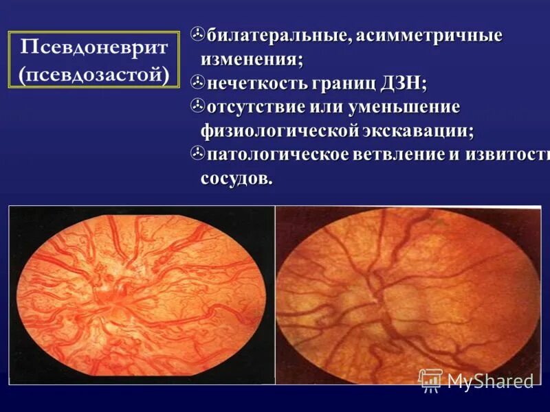 Псевдозастой зрительного нерва это. Псевдозастойный диск зрительного нерва. Друзы ДЗН псевдозастой зрительного нерва. Передняя ишемическая нейропатия