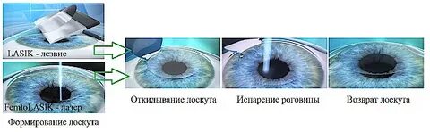 Фемто ласик операция отзывы