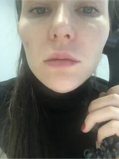 Отекают скулы