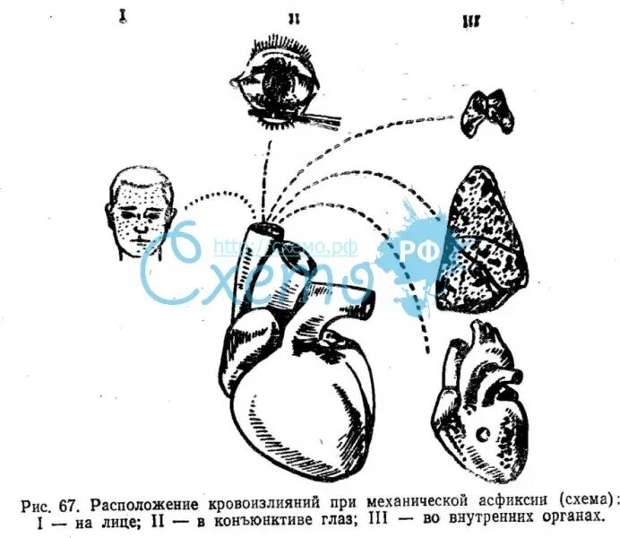 Классификация механической асфиксии судебная медицина. Травматическая асфиксия схема. Механическая асфиксия симптомы. Признаки при различных видах механической асфиксии. Асфиксия судебная