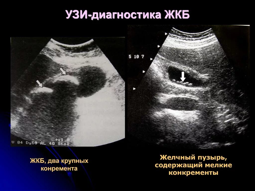 Эхогенный желчный пузырь. УЗИ желчного пузыря при ЖКБ. Желчный пузырь на УЗИ холелитиаз. Болезни желчного пузыря на УЗИ. Желчнокаменная болезнь УЗИ.