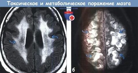 Поражение вещества головного мозга