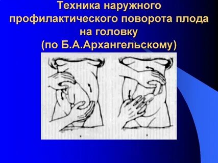 Поворот плода