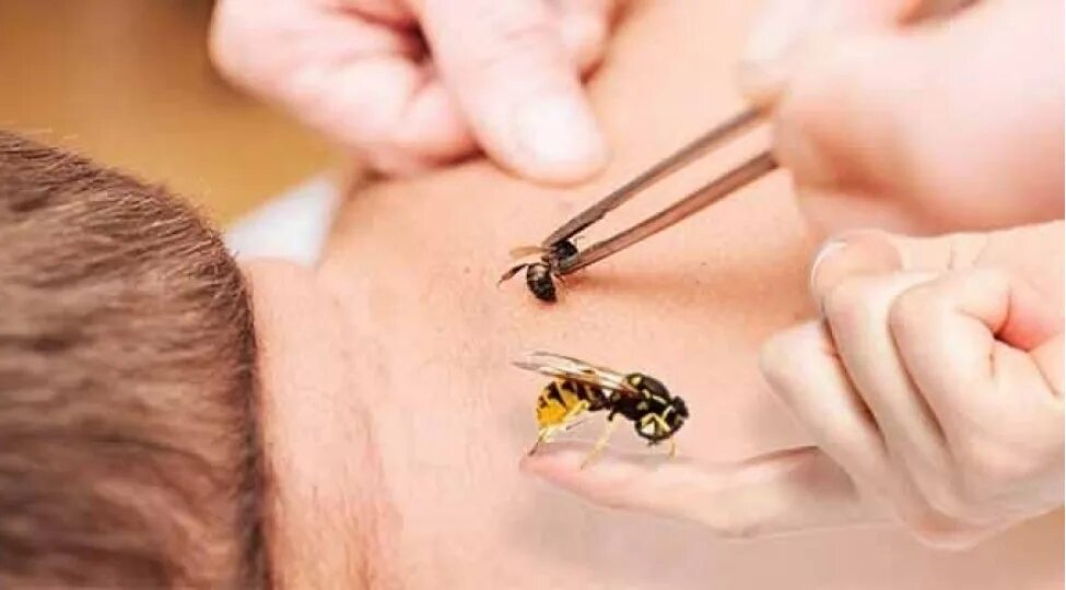 Пчелиный яд апитерапия. Терапия ужаливания пчелой. Апитерапия показания. Апитерапия. Шмель пчела оса шершень укусы.