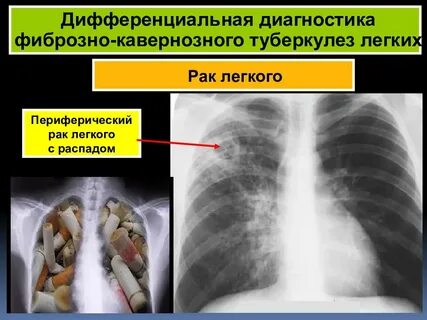 Фиброзно кавернозный туберкулез диагноз
