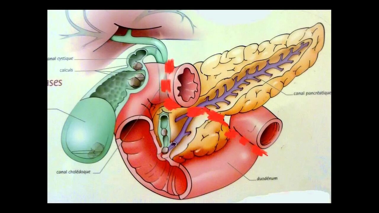 Поджелудочная железа камни удаление. Обтурация протоков поджелудочной железы. Воспаленная поджелудочная железа. Камень в протоке поджелудочной.