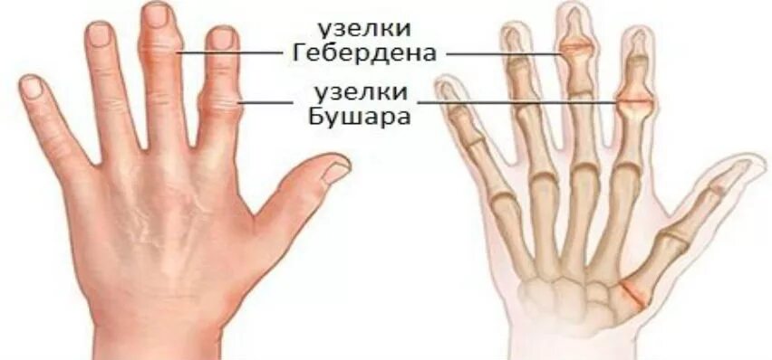 Болит сустав у основания большого пальца руки. Узелки Гебердена и Бушара. Узелки Гебердена и Бушара ревматоидный артрит. Подкожные узелки ревматоидный артрит. Ревматоидный артрит на мизинце.