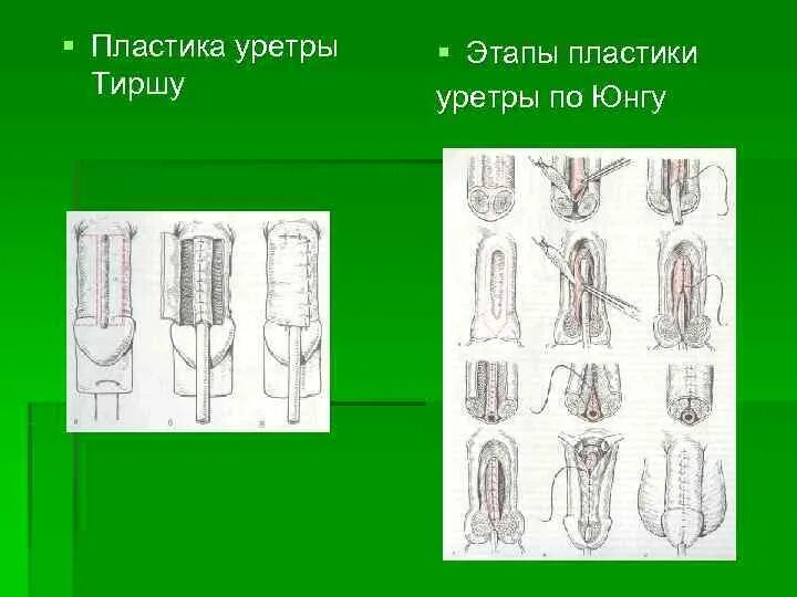 Эписпадия и гипоспадия. Эписпадия и гипоспадия операции. стволовая форма эписпадии. стриктура уретры пластика.