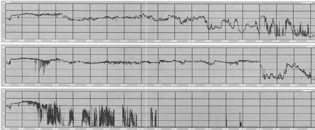 Рн-мониторинг. Рн грамма. Ph метрическое исследование пищевода. График суточного ph желудка. Суточная ph метрия пищевода.