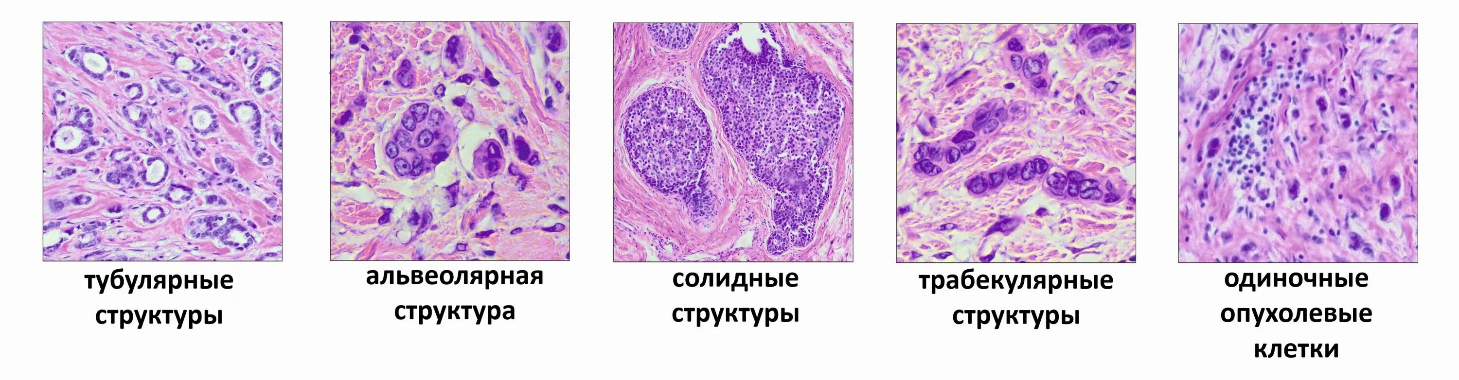 Клетка доброкачественной опухоли. Протоковый карцинома гистология. Аденокарцинома печени гистология. Протоковая карцинома молочной железы микропрепарат. Карцинома молочной железы гистология.