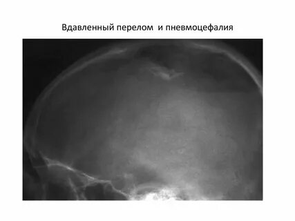 Пневмоцефалия