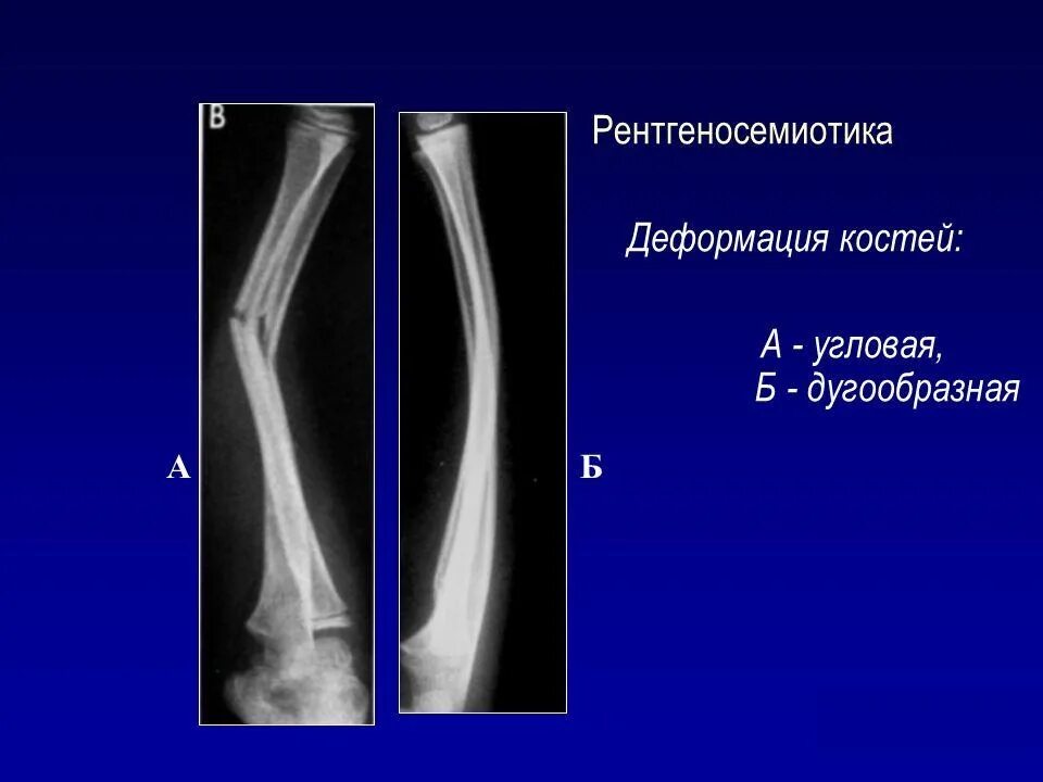 Деформация костей фото