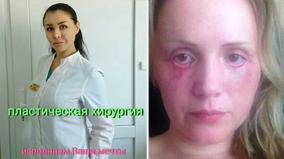 жертвы пластического хирурга алены верди. алена верди хирург краснодар. хирургическая операция. вице мисс россия юлия тарасевич. доктор франкенштейн алена верди.