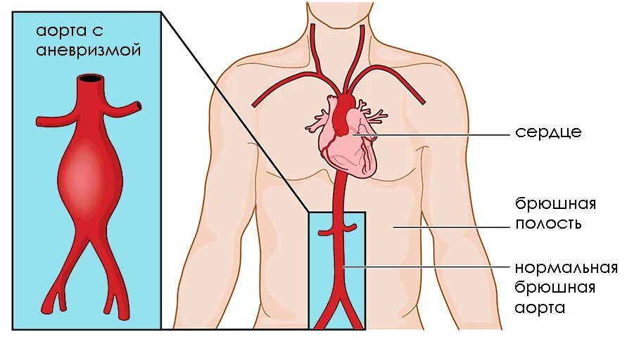 Аневризма сердца что это такое симптомы. Аневризма аорты разрыв. Разрыв сердечеой хорды. Разрыв межсердечной аорты.