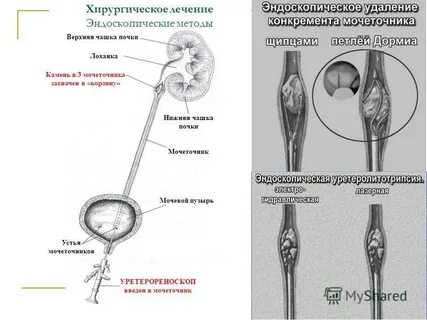 Через какое время выйдет камень