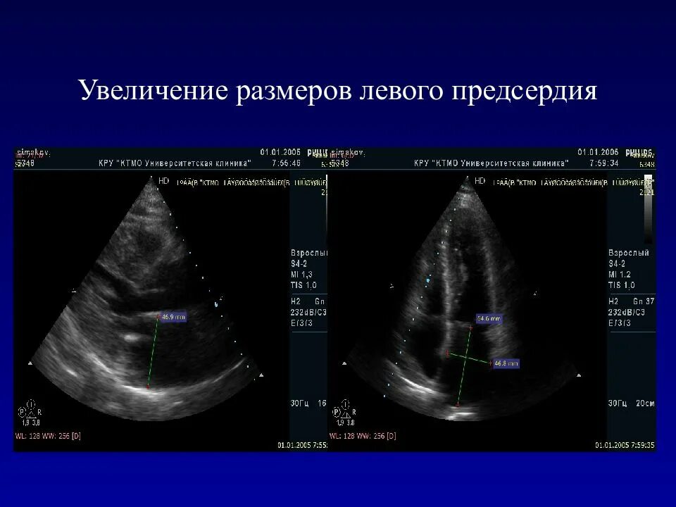 Расширение левого предсердия на ЭХОКГ. Объем левого предсердия в норме ЭХОКГ. Левое предсердия Эхо кг. Трансмитральный поток эхокардиография. Увеличено правое предсердие