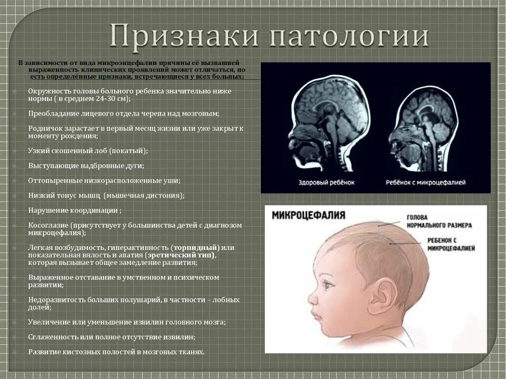 Без видимых патологий. Морфофункциональная незрелость головного мозга новорожденного это. Микроцифалияголовного мозга. Микроцефалия головного мозга у ребенка. Череп микроцефальной формы.